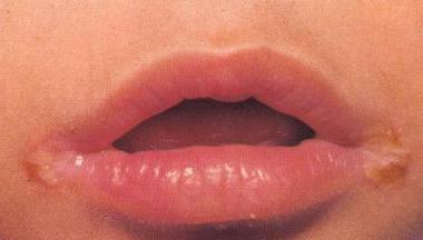 Halit auf den Lippen: Arten, Ursachen und Behandlung