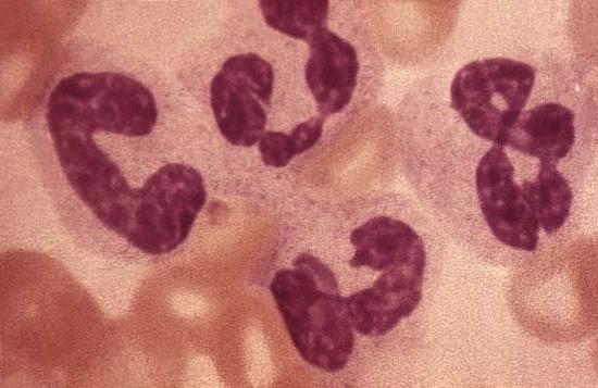 Leukozytose im Blut: ein Krankheitszeichen?